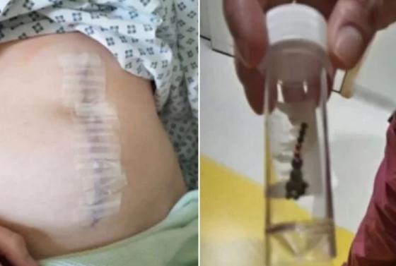 Jovem perde parte do intestino após “desafio do piercing” no TikTok