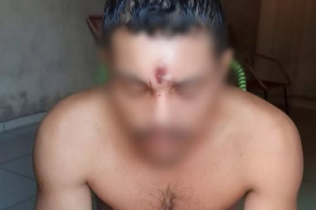 Homem leva tiro na testa, cai de moto e vai para casa dormir: neurocirurgião explica como isso é possível