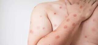 Ministério da Saúde confirma primeiro caso de nova cepa de Mpox no Brasil