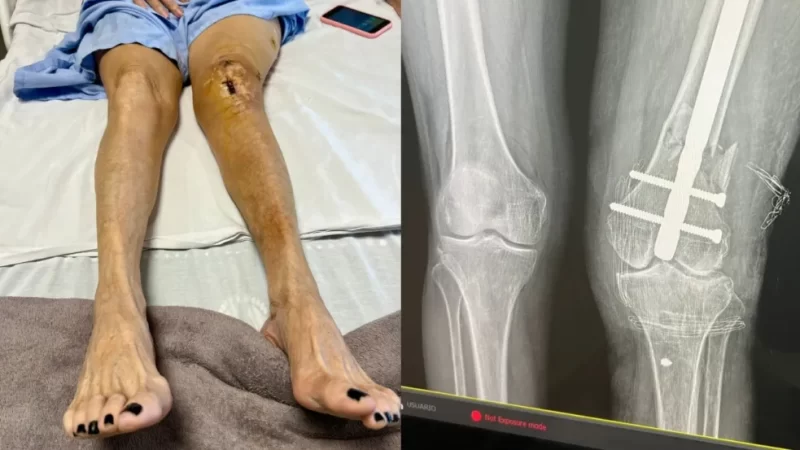 Servidor denuncia suposto erro em cirurgia que deixaria idosa com perna torta