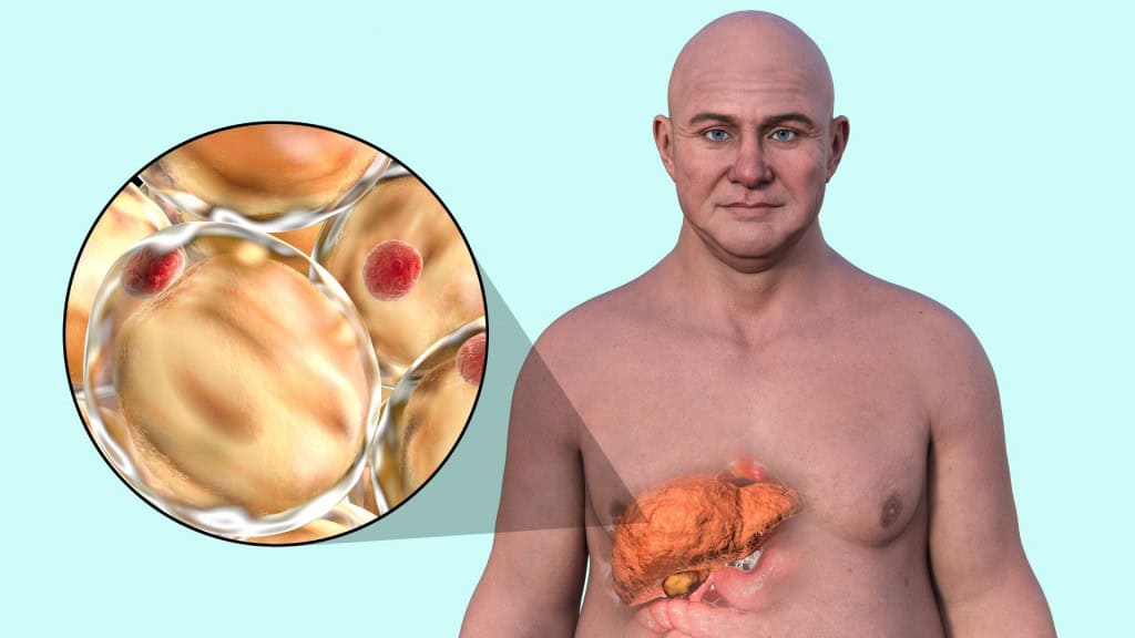 Ozempic pode eliminar a gordura no fígado, segundo estudo